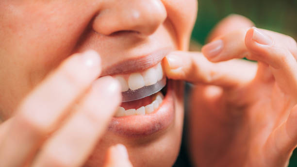 Do Teeth Whitening Strips Work?