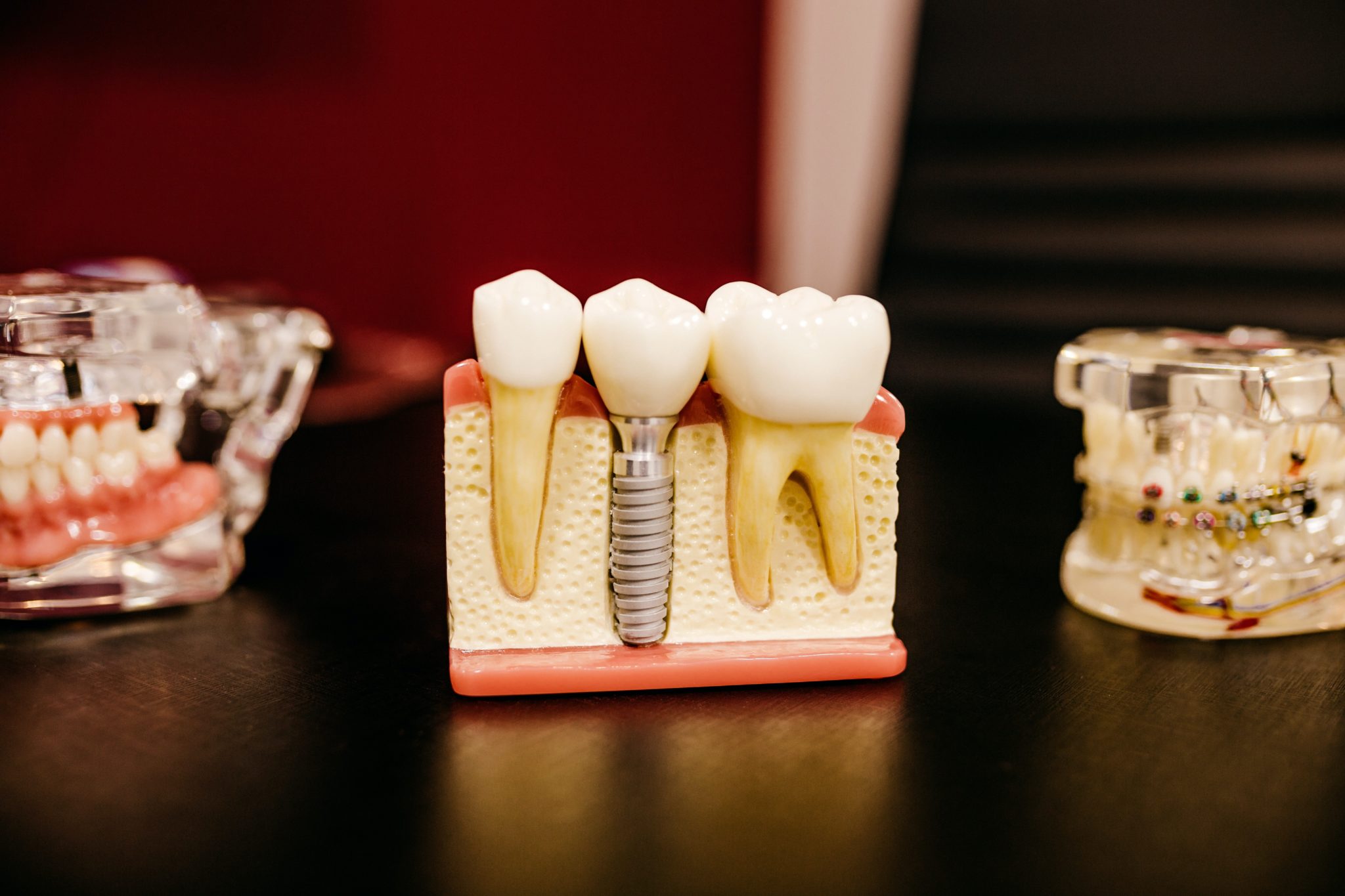 Dental Implants as the Best Solution for Teeth Replacements