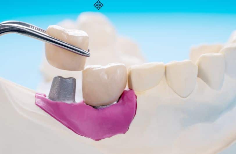 What Is a CEREC Crown? A Fast, Efficient Way to Restore Your Smile in Coral Springs